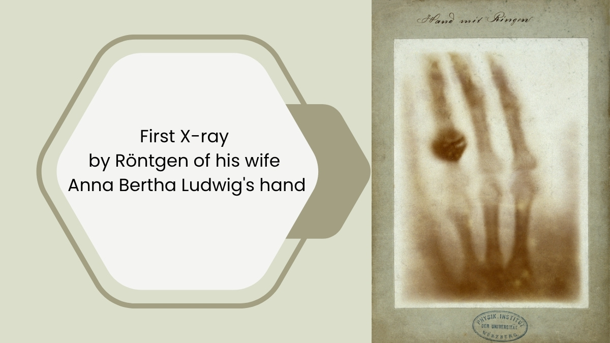 First X-ray  by Rontgen