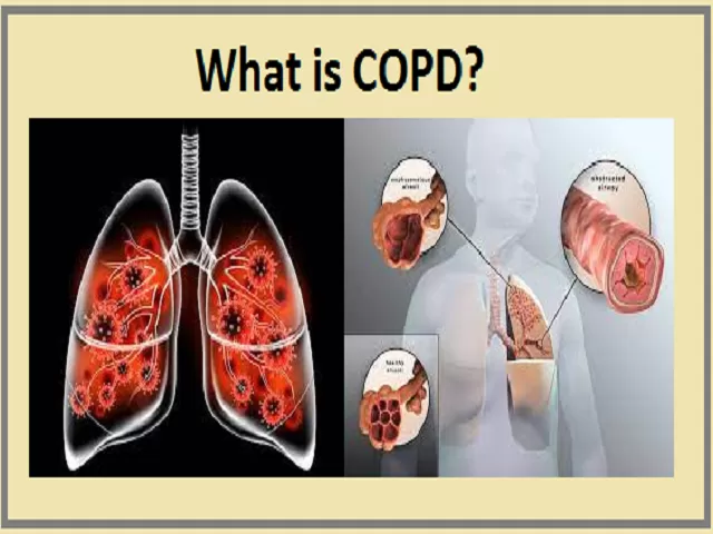 World COPD Day 2021: Know about COPD, its Causes, Symptoms, Preventive ...