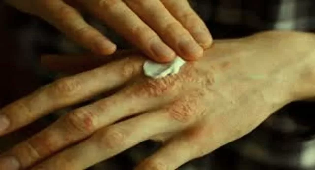 World Psoriasis Day: Know that Vitamin D can benefit people with psoriasis