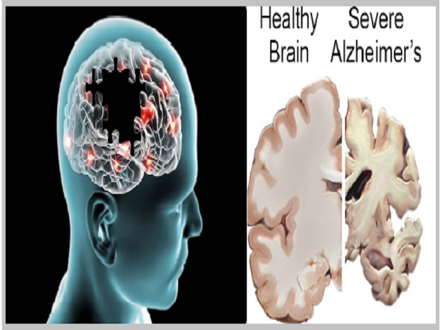 World Alzheimer's Day 2021: All about Alzheimer's disease, Symptoms, Cause, and Prevention