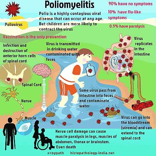 EXPLAINED: Cases Of Polio Alarm London, Jerusalem, And New York. Know ...