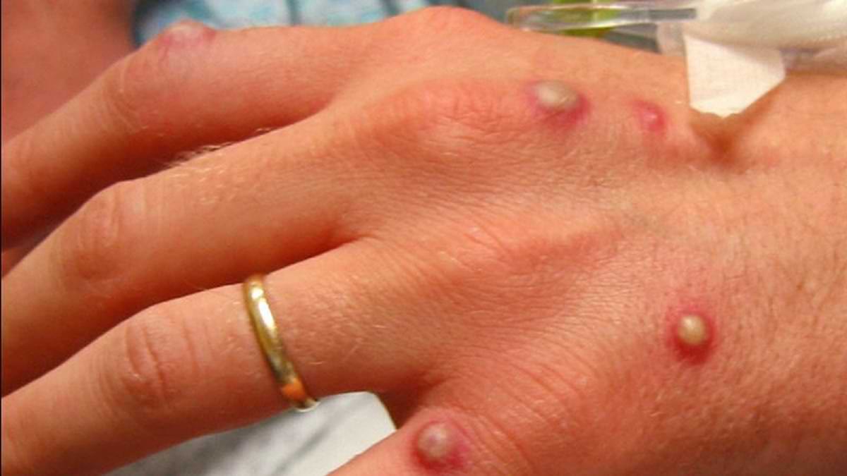 Monkeypox Cases in India 2022: 31-year-old woman tests positive for Monkeypox in Delhi, How to avoid Monkeypox?
