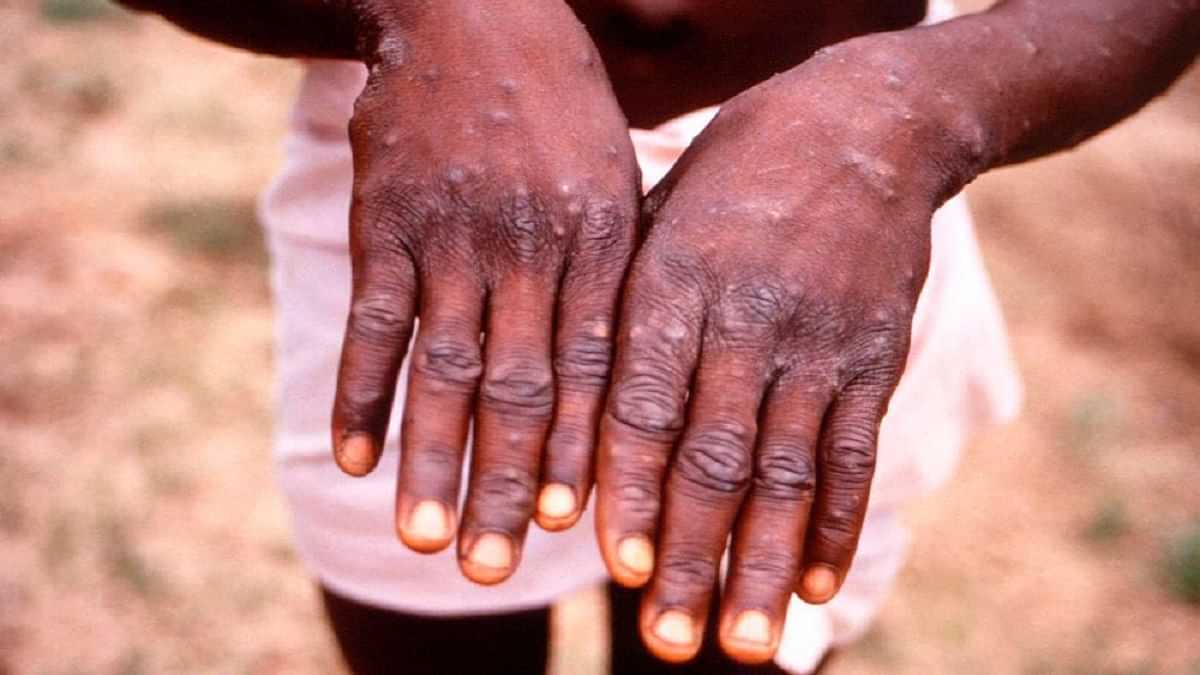 Monkeypox Do's and Don'ts: स्वास्थ्य मंत्रालय ने मंकीपॉक्स से बचने के लिए क्या करें और क्या न करें की सूची जारी की