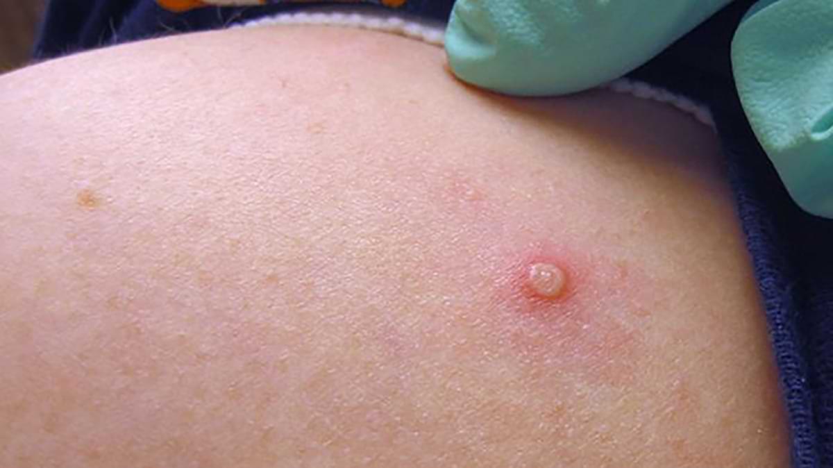 Suspected Monkeypox symptoms detected in traveller from UAE