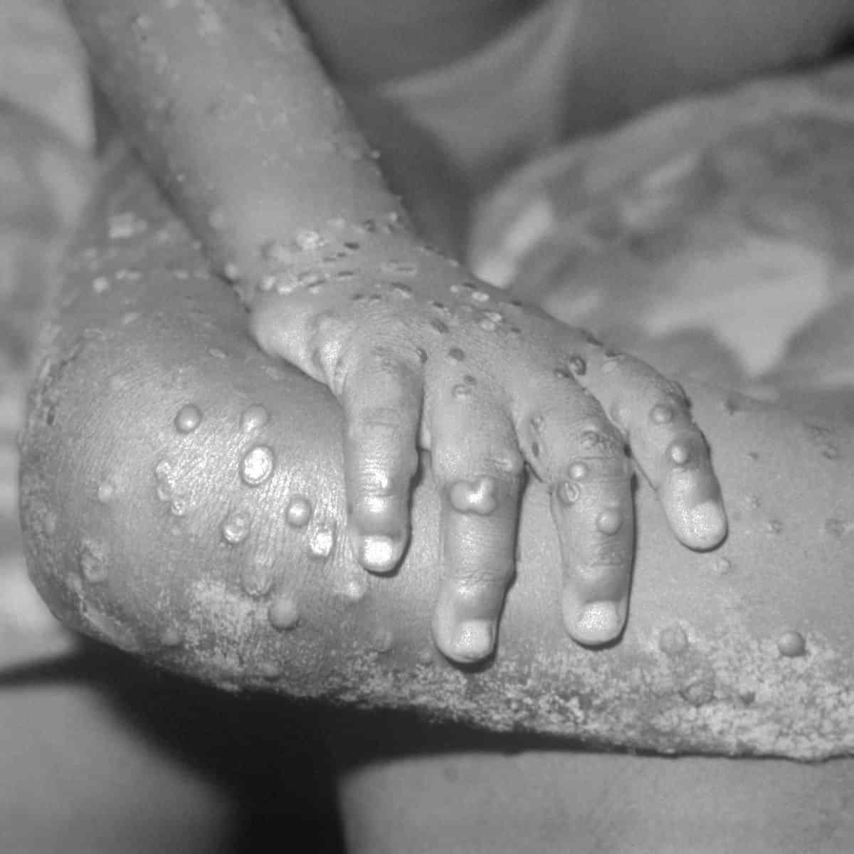 Health Ministry issues guidelines for Monkeypox management