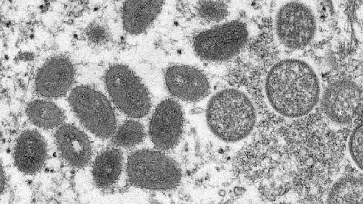 Monkeypox Symptoms, Treatment, Vaccine: How does it spread, is it fatal or not?