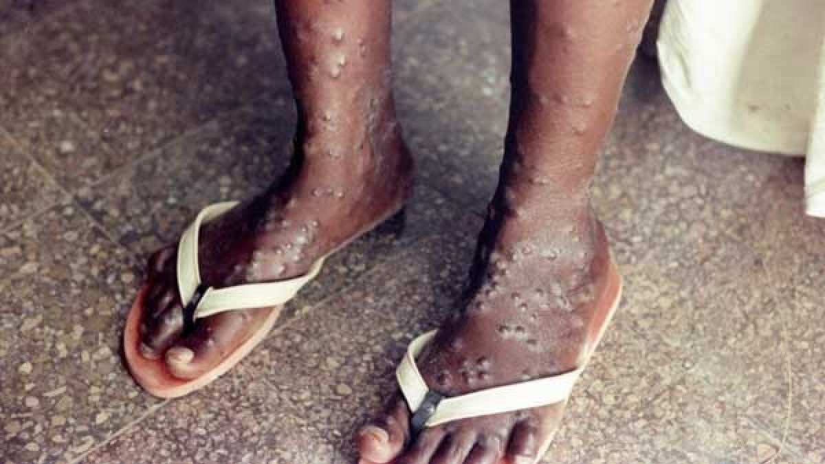Monkeypox Infection Control: Government issues guidelines on management of Monkeypox disease