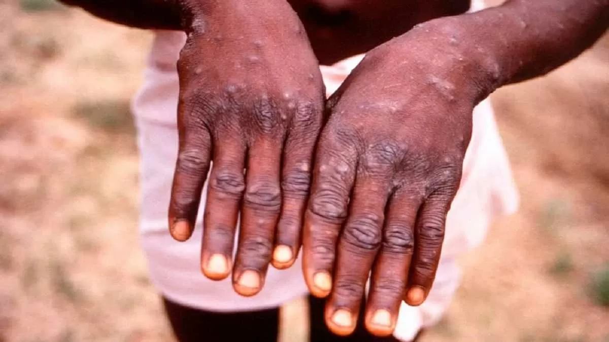 Monkeypox outbreak declared a public health emergency