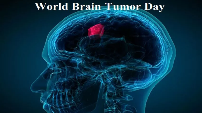 WORLD BRAIN TUMOR DAY - June 8 - National Day Calendar