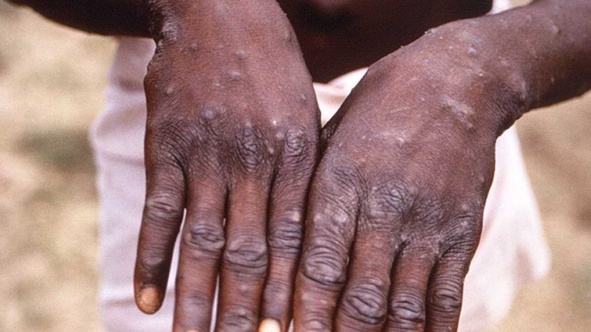 Monkeypox virus outbreak: मंकीपॉक्स वायरस तेजी से क्यों फैल रहा है?