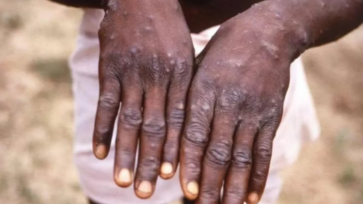 Monkeypox outbreaks