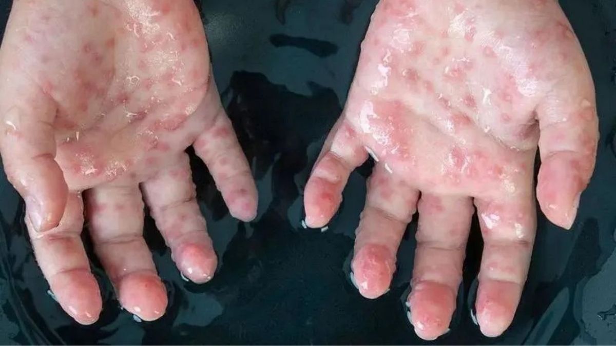 Monkeypox outbreak: क्या कोरोना से भी खतरनाक है मंकीपॉक्स? इन लक्षणों को न करें नजरअंदाज
