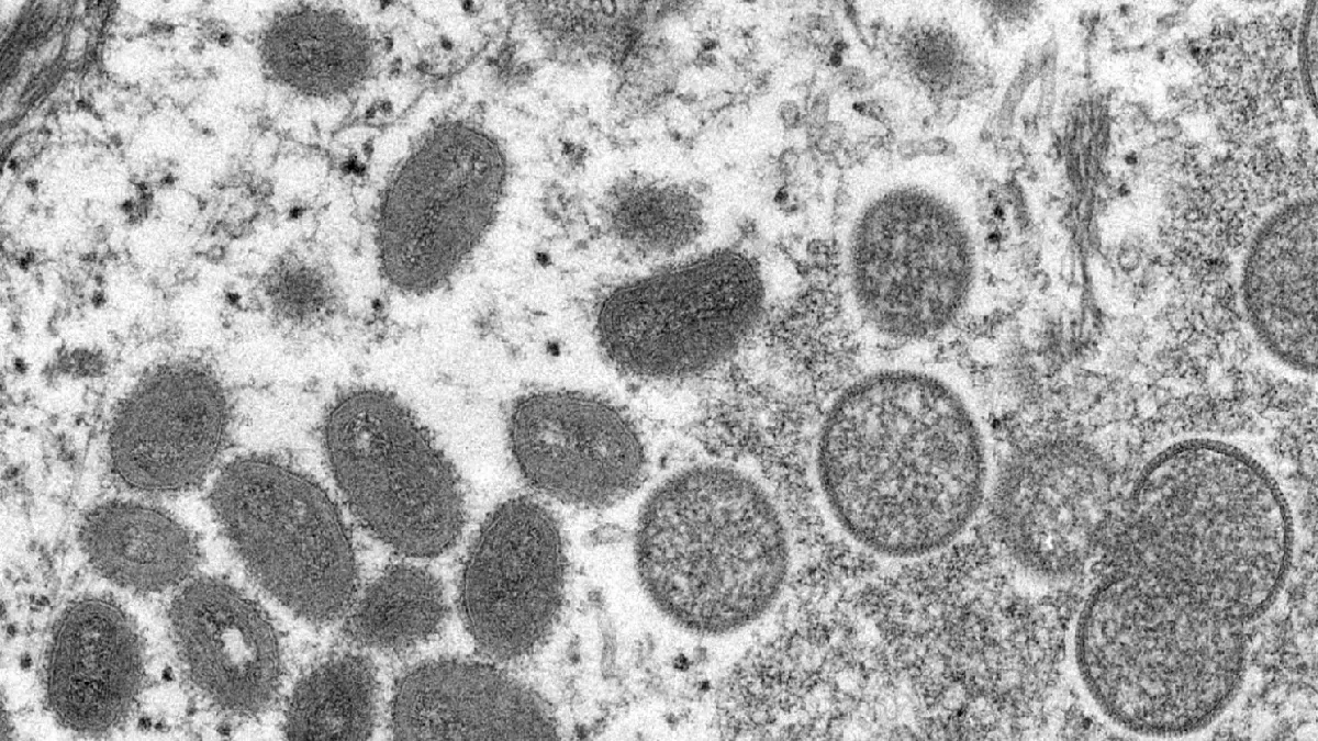 Monkeypox cases in India