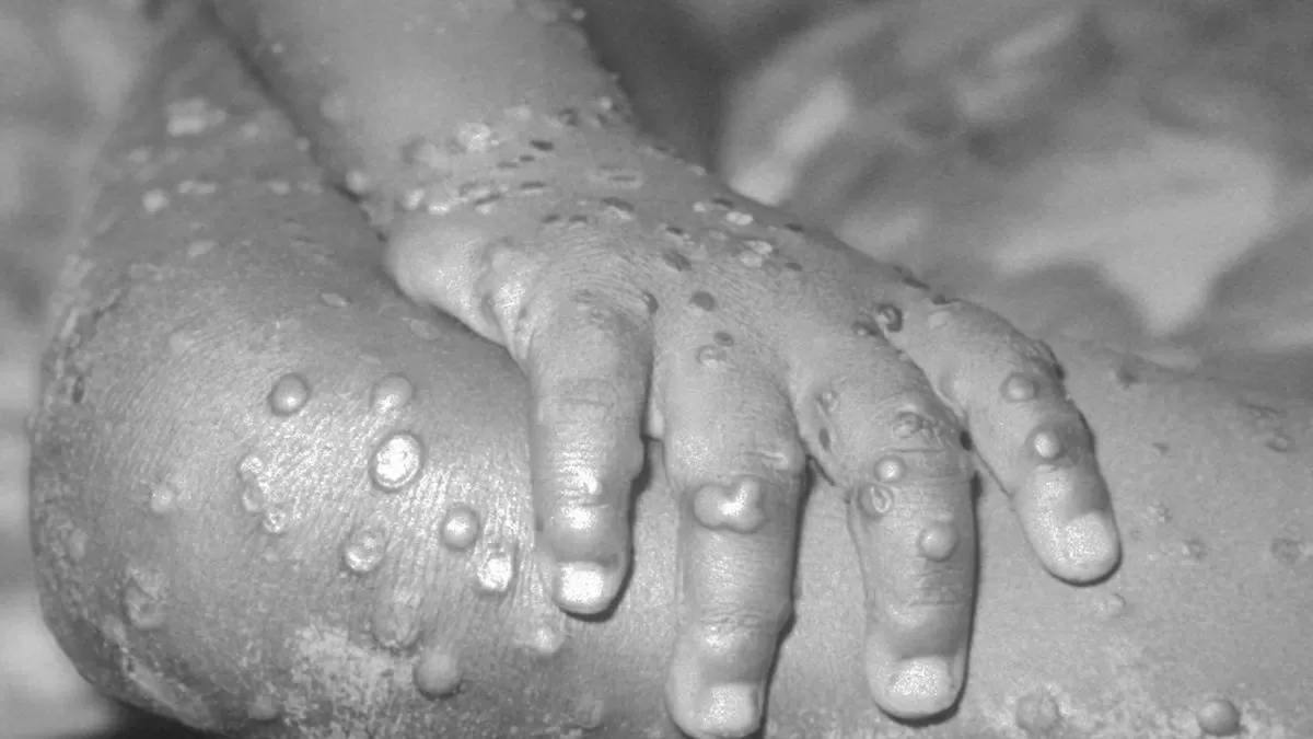 Check List of Countries Where Monkeypox Disease Cases have been Confirmed