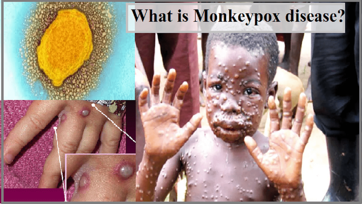 Monkeypox Virus Outbreak: What is monkeypox disease? Know Monkeypox  Symptoms, Cases and Treatment Here