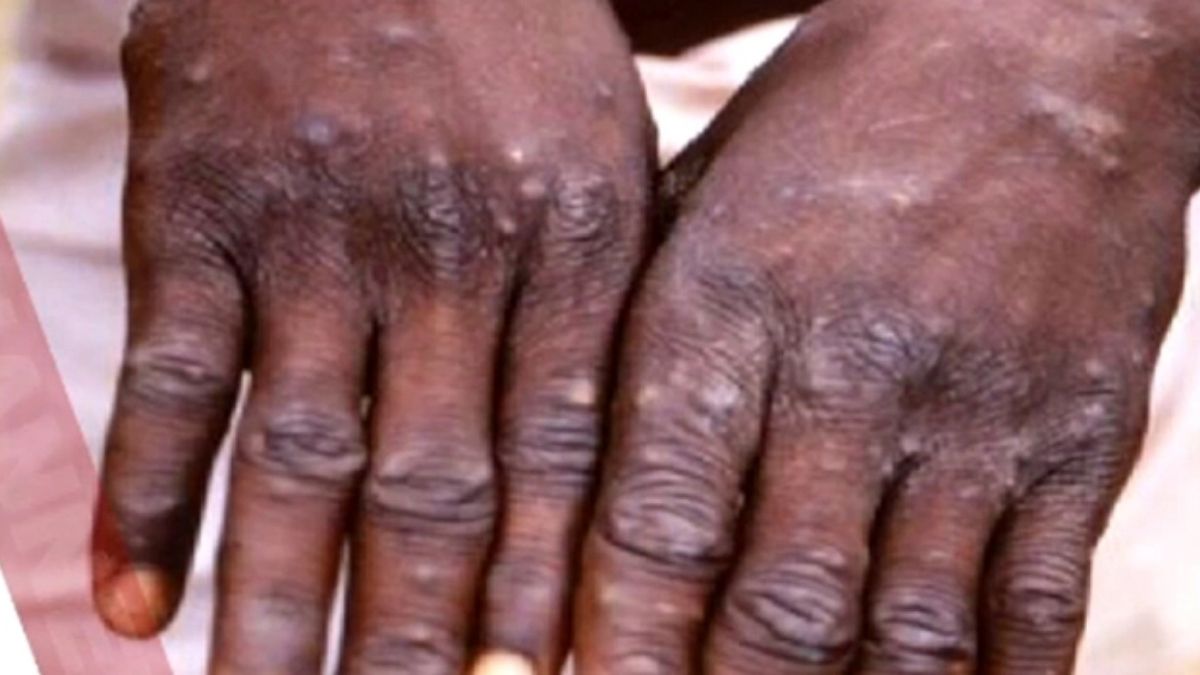 Monkeypox in India: नहीं थम रहा है मंकीपॉक्स का कहर, क्या यह दूसरी महामारी का वजह बन सकता है?