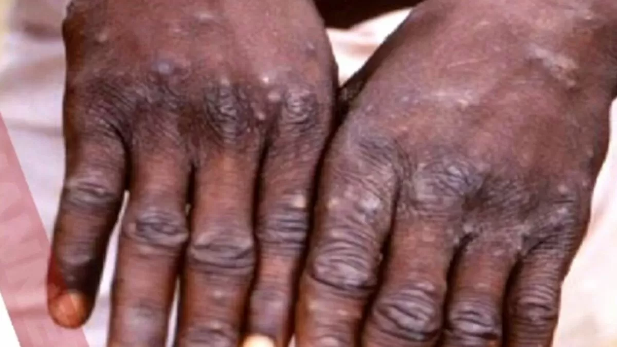 Monkeypox in India