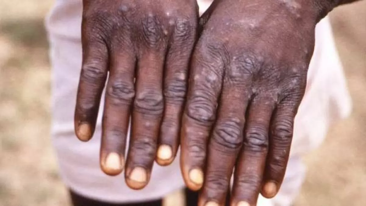 Monkeypox outbreak
