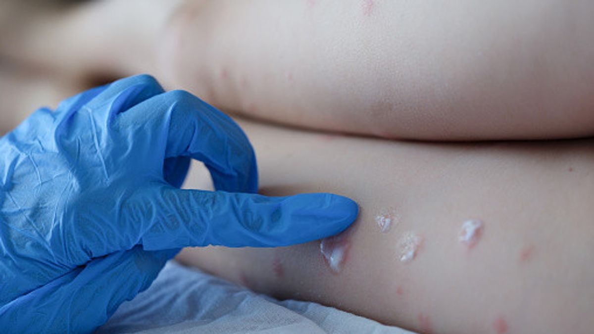 Is There a Treatment for Monkeypox?