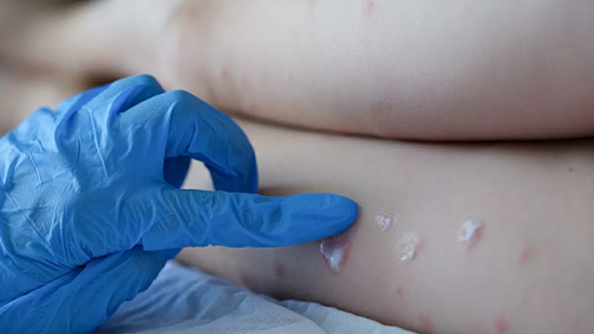 Vaccines, treatments for Monkeypox