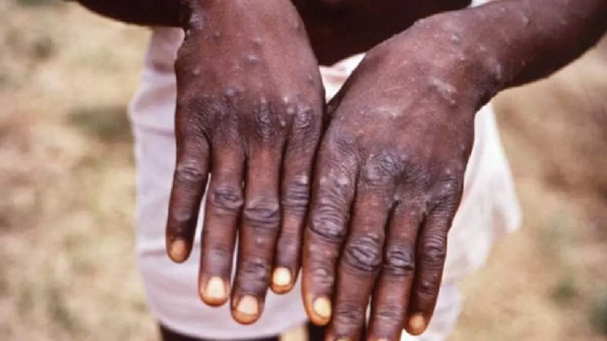 Monkeypox Case in UK