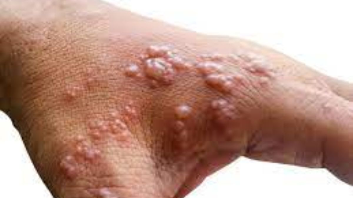 Monkeypox Virus in UK: मंकीपॉक्स बीमारी क्या है, जिससे ब्रिटेन में मचा हड़कंप