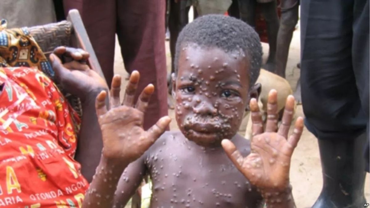 Monkeypox Situation Is Deteriorating People Should Be Careful Who Warning