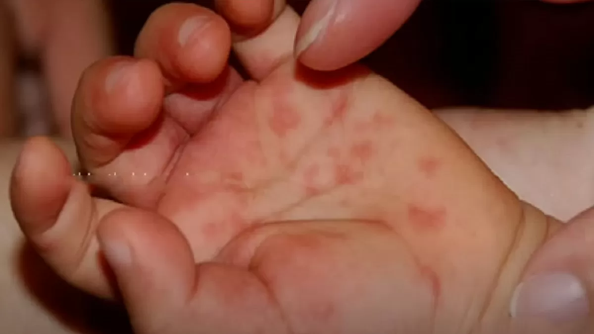 Kerala reports at least 82 cases of Tomato Fever