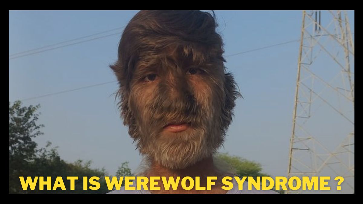 What is Werewolf Syndrome? Hypertrichosis : All you need to know