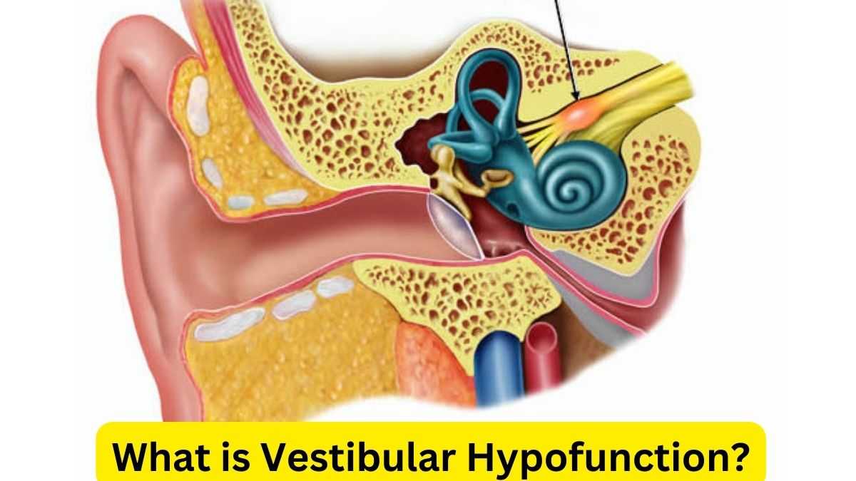 What is Vestibular Hypofunction?