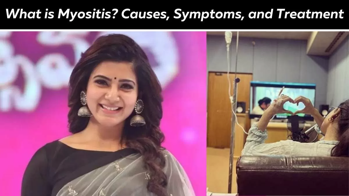 What Is Myositis The Autoimmune Condition Actress Samantha Ruth Prabhu 