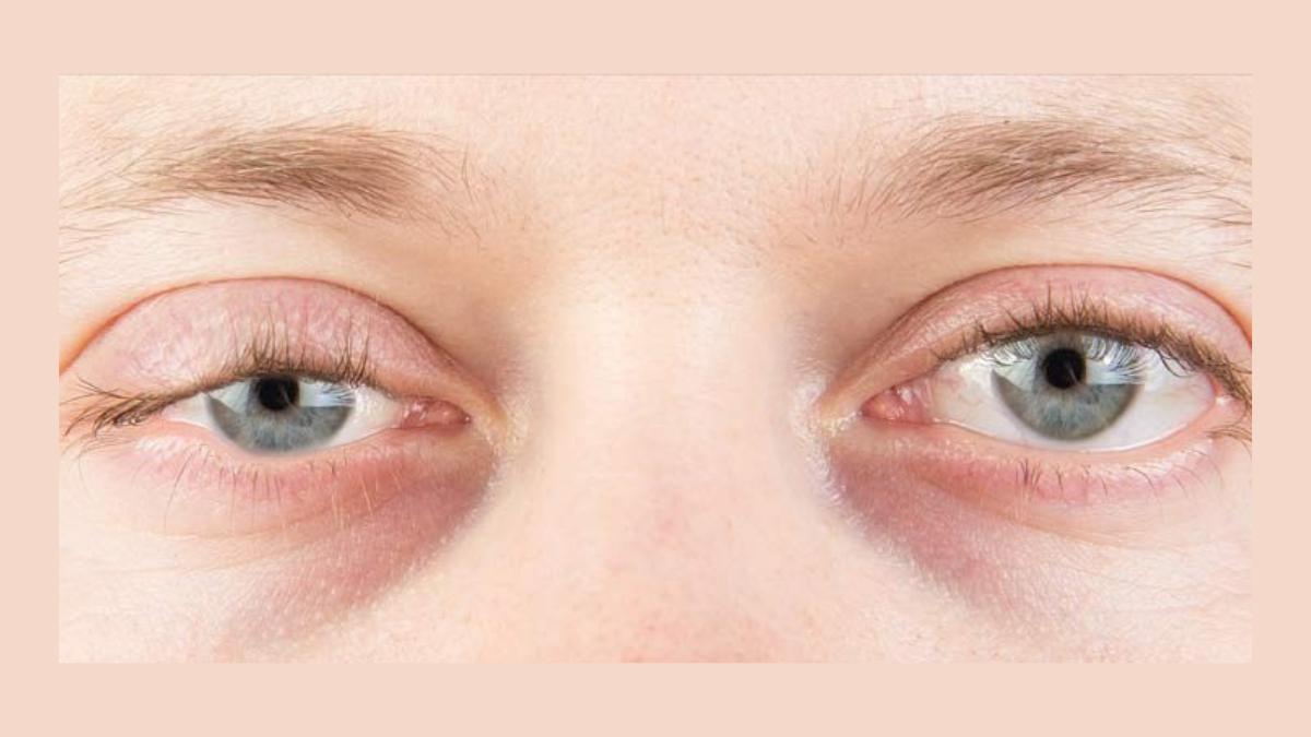 what-is-myasthenia-gravis-causes-symptoms-and-treatment