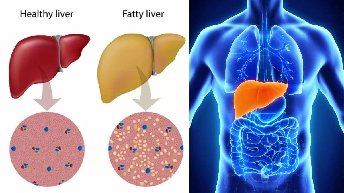 Healthy Liver vs Fatty Liver