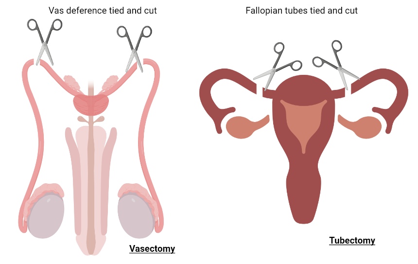 surgical methods of contraceptives