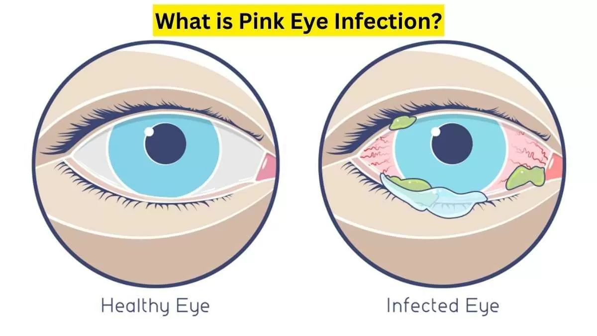 Is Pink Eye Infection