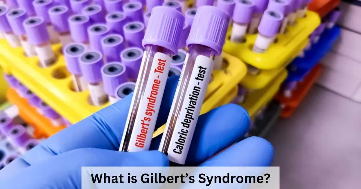 Know all about Gilbert Syndrome