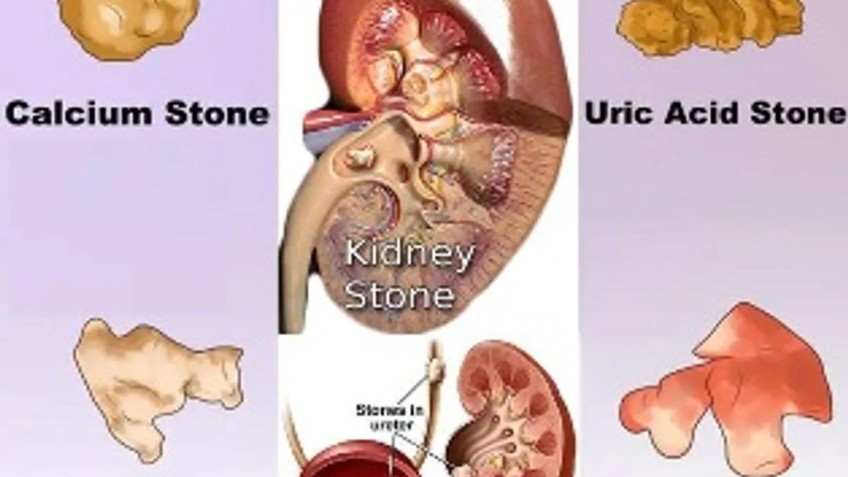 Different types of Kidney Stones