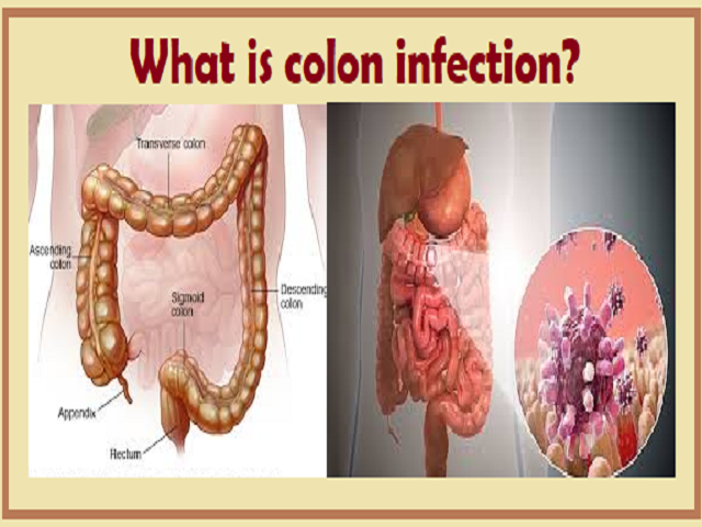 infectious colitis disease