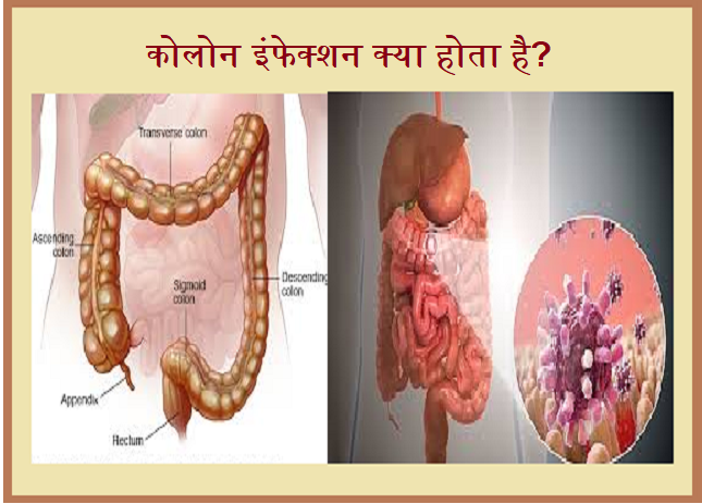 hindi-what-is-colon-infection