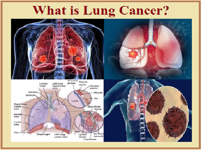 Types Of Lung Cancer Tumors