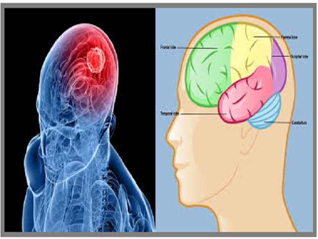 Glioblastoma multiforme type iv