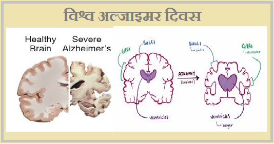 World Alzheimer Day 2019: History and Facts