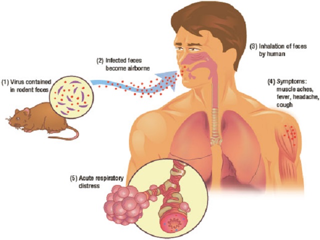  हंता वायरस (Hantavirus) क्या है और कैसे फैलता है?